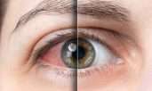 En sık görülen göz hastalıkları nelerdir