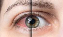 En sık görülen göz hastalıkları nelerdir